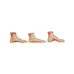 HOLLOW FOOT (PES CAVUS)