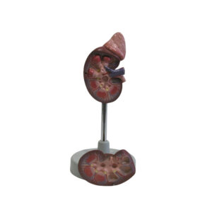 HUMAN KIDNEY STONE MODEL