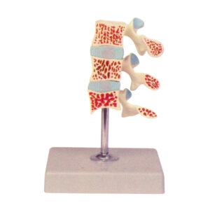 OSTEOPOROSIS MODEL (3 VERTEBRAE), DELUXE