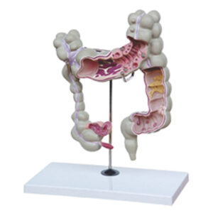 COLON (COMMON PATHOLOGY)